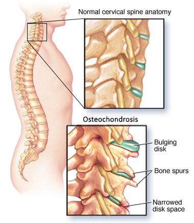 servikal osteokondroz
