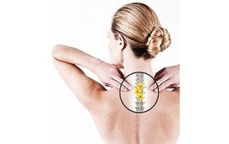 bir kadında servikal osteokondroz