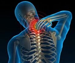 servikal omurganın osteokondrozu