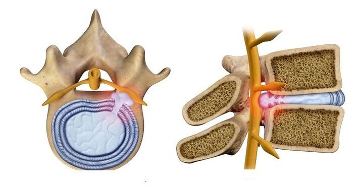 İntervertebral disk hernisi - disk çekirdeğinin omurilik kanalına çıkması